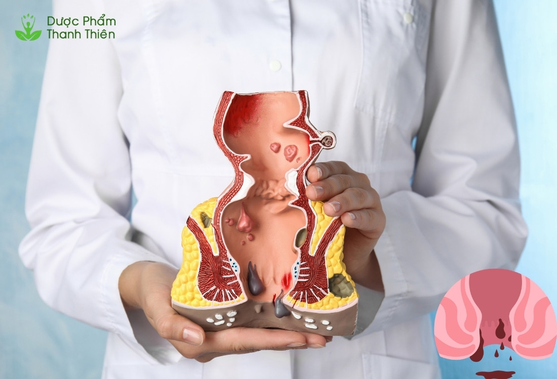 Trĩ là một trong những biến chứng phổ biến nhất của táo bón nặng