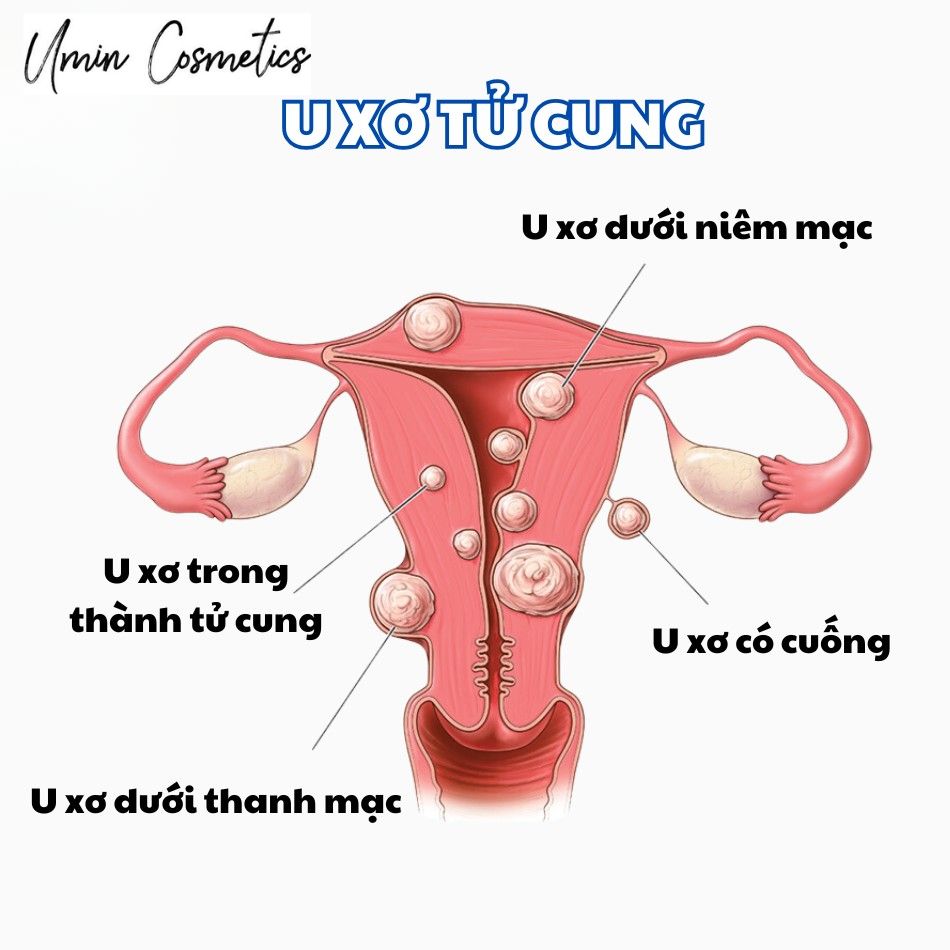 Các loại u xơ tử cung