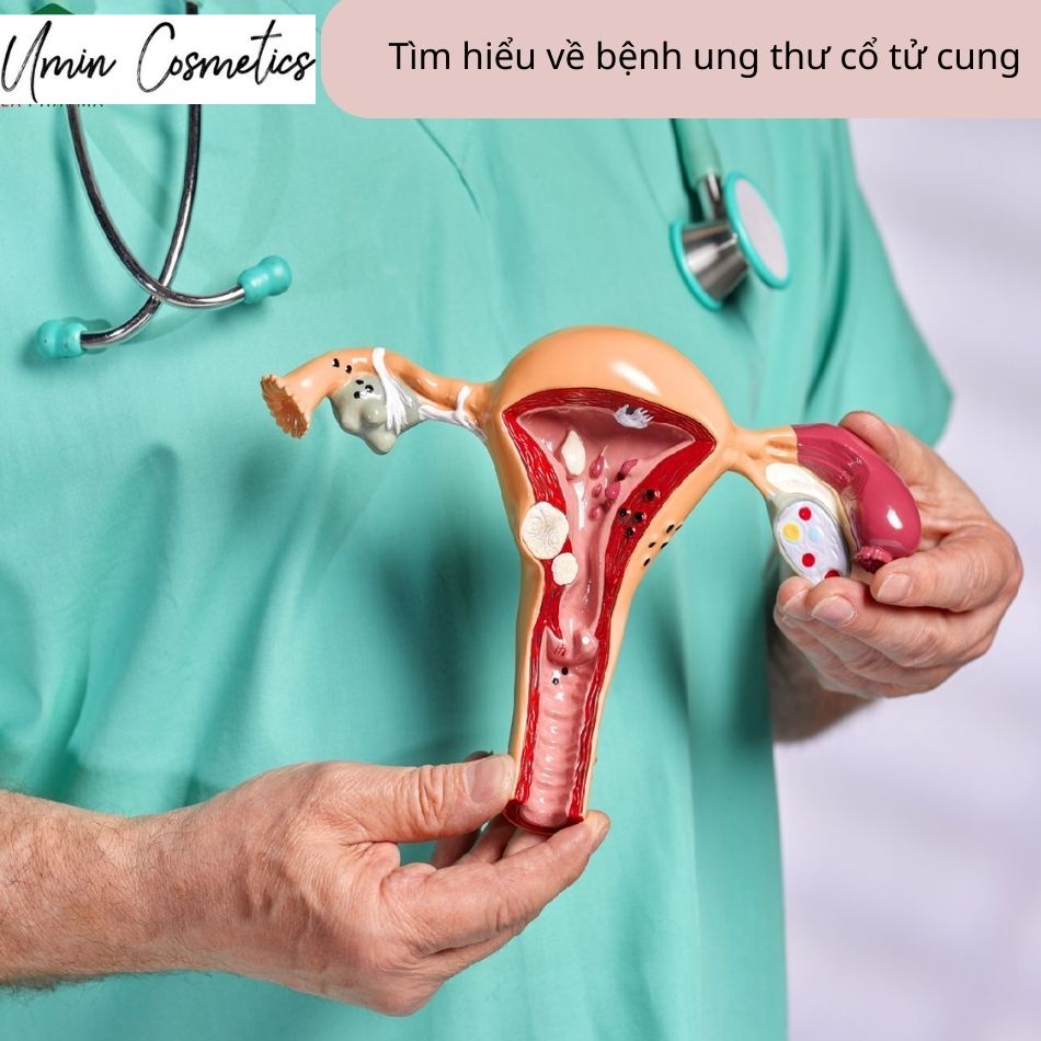 Tổng quan về bệnh ung thư cổ tử cung