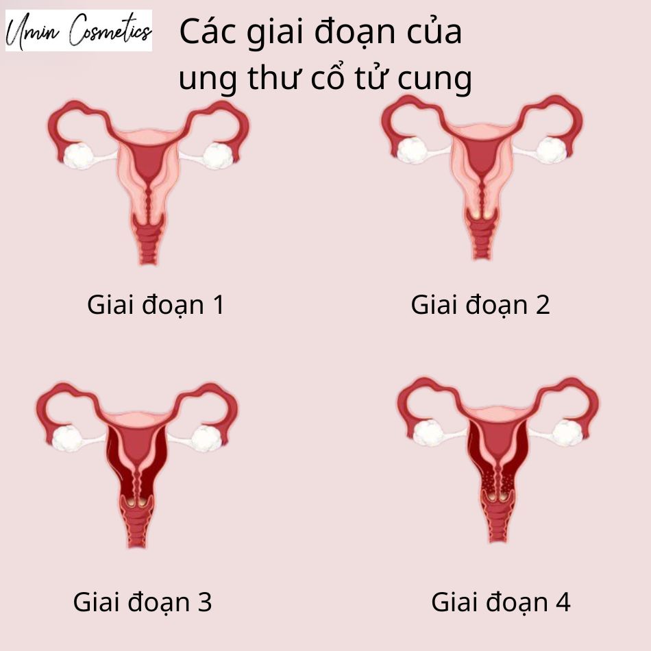 Các giai đoạn phát triển ung thư cổ tử cung