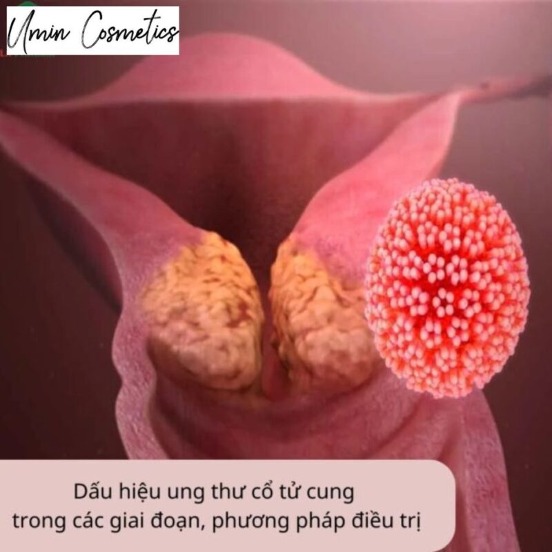 ung thư cổ tử cung