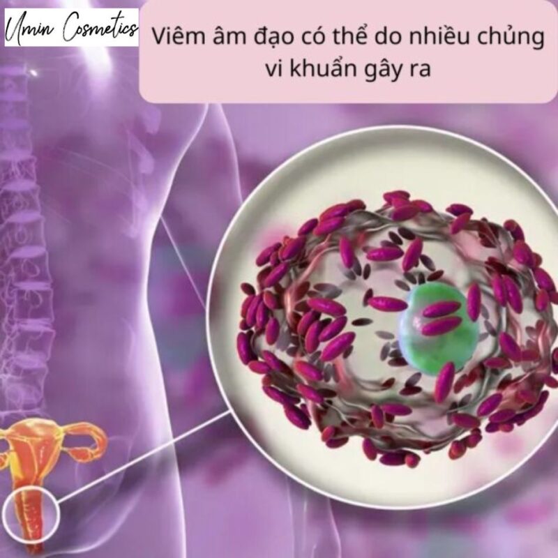 viêm âm đạo do vi khuẩn