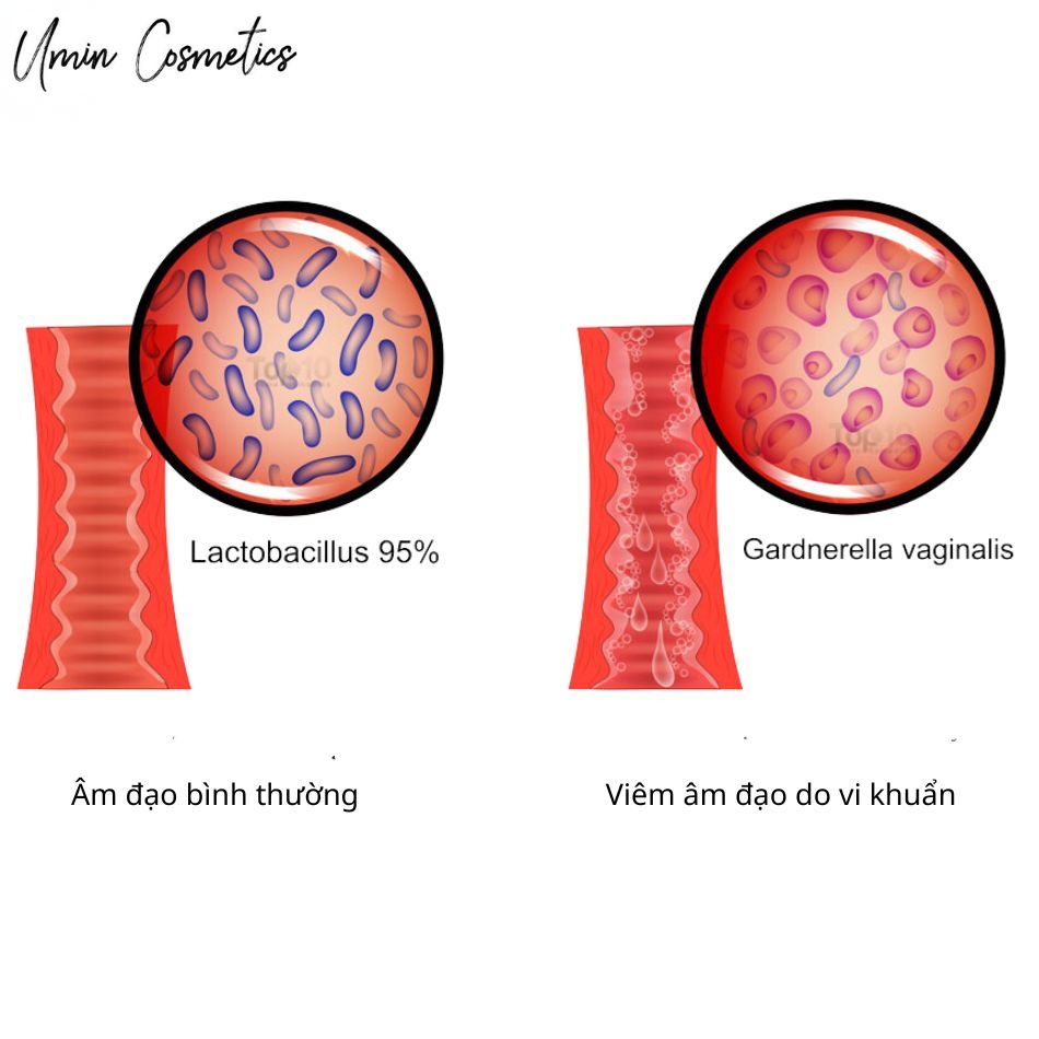 Hình ảnh âm đạo bị viêm