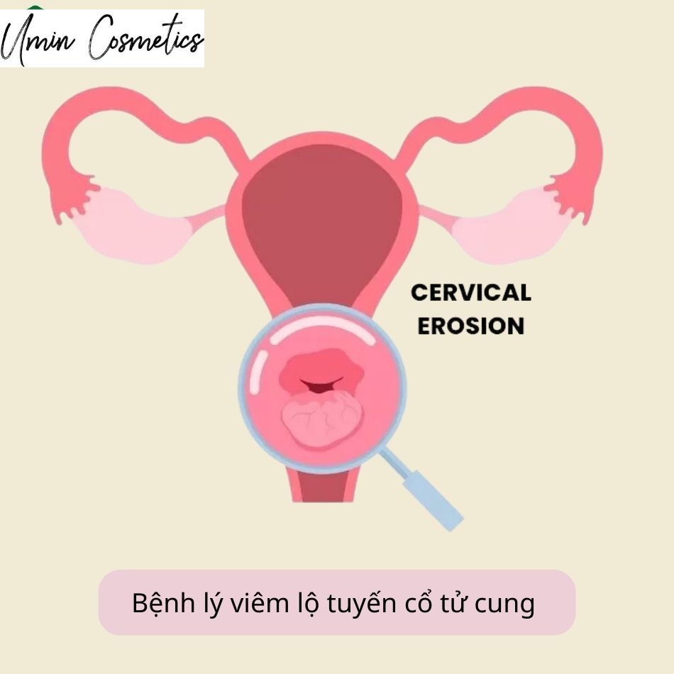 Viêm lộ tuyến xảy ra nhiều ở đối tượng phụ nữ